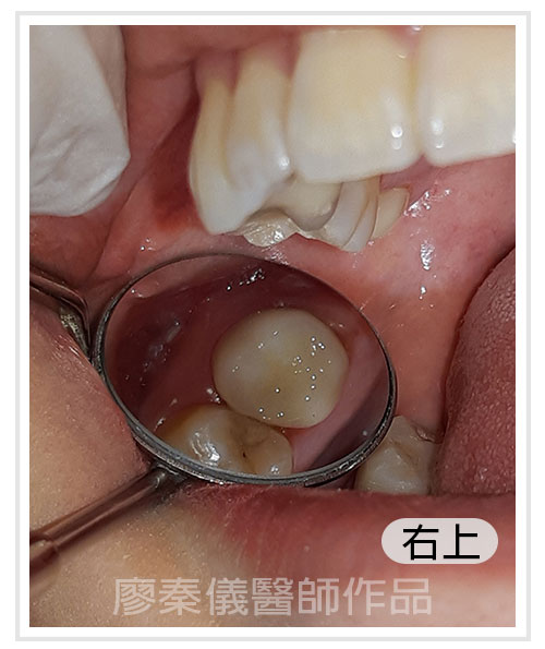 3D齒雕,竹北3D齒雕,美容牙科,晶鑽全瓷,新竹牙裂,竹北牙裂,新竹牙斷,竹北牙斷