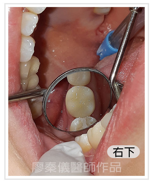 3D齒雕,竹北3D齒雕,美容牙科,晶鑽全瓷,新竹牙裂,竹北牙裂,新竹牙斷,竹北牙斷
