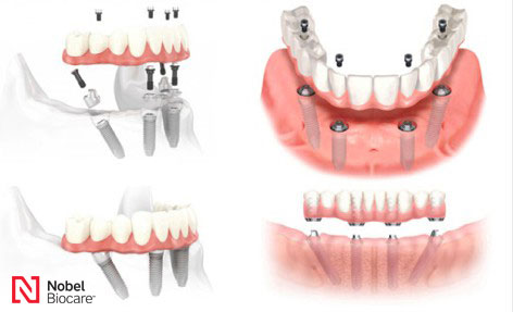 ALL ON 4全口植牙,竹北牙醫,all on 4全口植牙費用,植牙