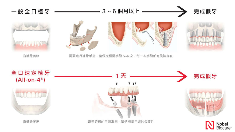 ALL ON 4全口植牙,竹北牙醫,all on 4全口植牙費用,植牙